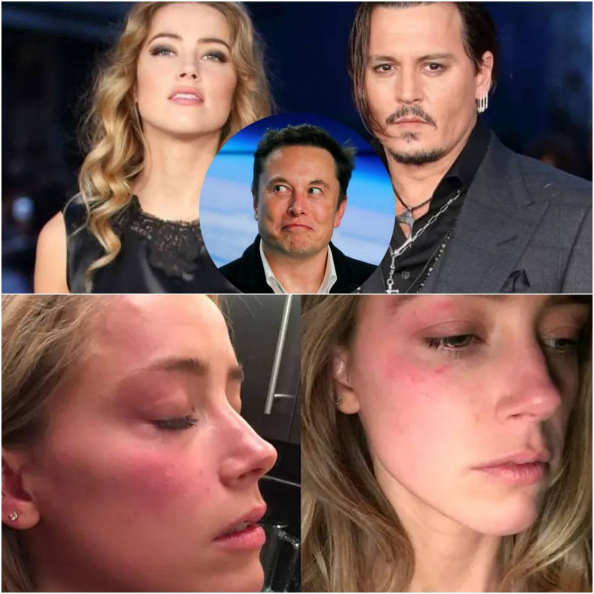 They Believe That The Bruise On Amber Heards Cheek Was Caused By Billionaire Elon Musk Not